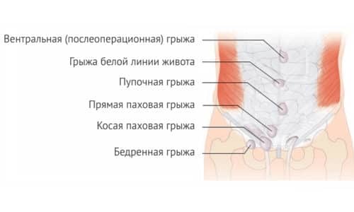 Как проводится операция грыжи белой линии живота?