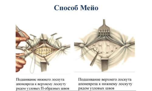 Швы накладываются в виде буквы П. Этот способ наложения шелковых нитей является наиболее надежным