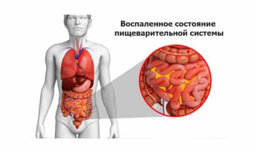 Перитонит - воспалительное поражение органов брюшной полости, сопровождается симптомами: сильные боли, напряжение стенок живота, тошнота, рвота, слабость, повышение температурных показателей и т.д