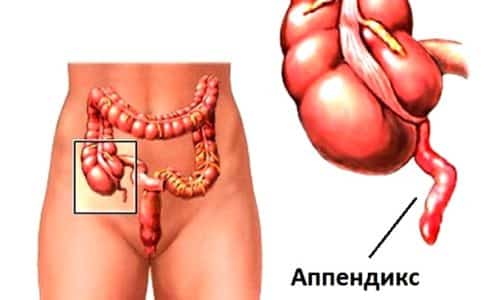 При пережатии сосудов в паховом кольце возникает воспаление в червеобразном отростке, тогда ставится диагноз острый аппендицит