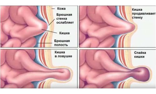 Операцию младенцам применяют при невозможности вправить органы, вышедшие в мешок