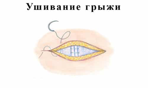 Ушивание грыжи открытым способом (герниография, грыжесечение) проводят под местной или общей анестезией