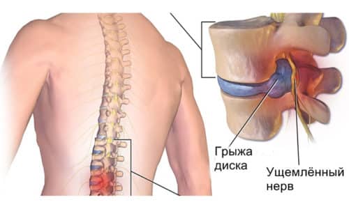 Грыжи межпозвоночных дисков могут возникать в любом отделе позвоночного столба: шейном, грудном, поясничном