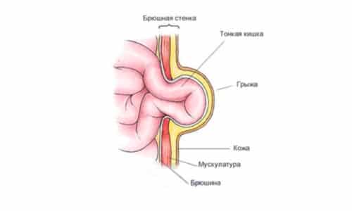 Пупочная грыжа у детей - это распространенное явление. Встречается у каждого пятого малыша, а среди недоношенных детей - почти у каждого третьего
