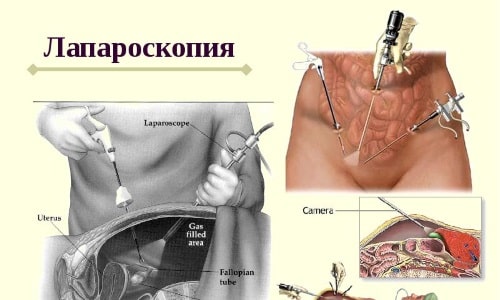 Лапароскопия включает в себя девять этапов