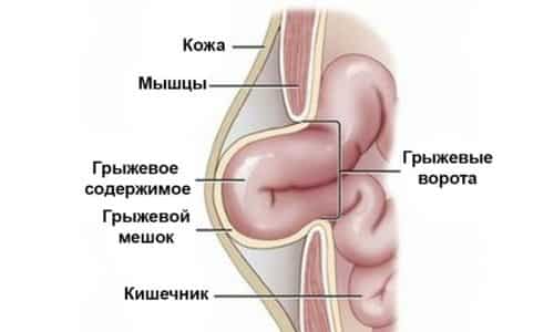 Виды и лечение ущемлённой паховой грыжи