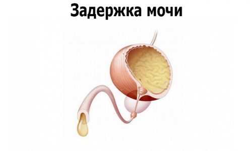 Секвестрирующая грыжа поясничного отдела приводит к различным отклонениям мочеиспускания