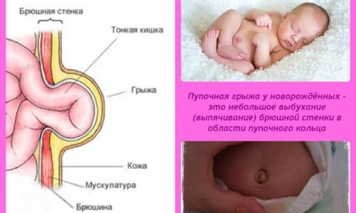 Такая острая патология, как ущемление пупочной грыжи у новорожденных, - явление редкое, но представляет опасность для жизни младенца