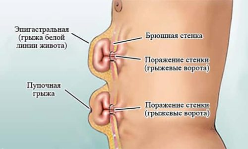 Что такое ущемленная пупочная грыжа?