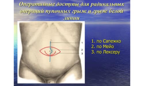 Как проводится грыжесечение пупочной грыжи по Мейо?