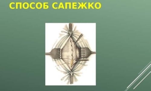 Операция может производиться стандартными способами: методами Сапежко или Мейо
