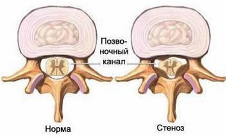 Что такое стеноз позвоночного канала