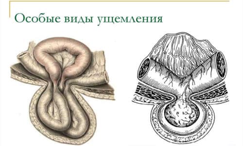 Тяжело диагностируется рихтеровское, или пристеночное, ущемление, это обусловлено тем, что в узкое кольцо попадает только небольшая часть стенки кишечной петли