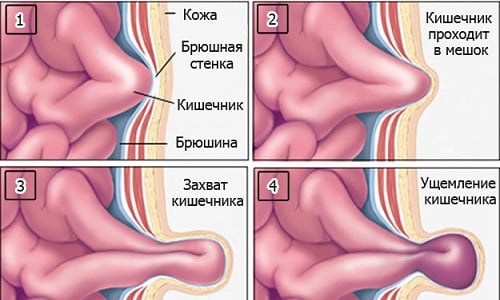 Грыжа может перейти в стадию ущемления - состояние, угрожающее жизни, когда петля кишечника или другие ткани брюшной полости сильно пережимаются в грыжевом мешке и снабжение их кровью ухудшается