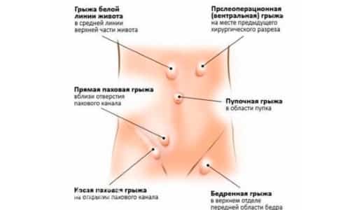 По анатомическому расположению грыжи делятся на паховые, грыжи спигелиевой линии, пупочные, диафрагмальные, тазовые