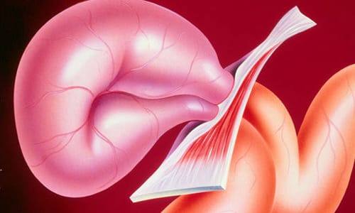 В ущемленном органе нарушается циркуляция крови, он меняет свой цвет, а грыжевое содержимое становится прозрачным, в результате развивается гангрена, которая вызывает непроходимость кишечника
