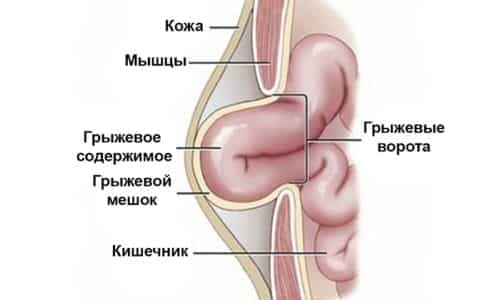 Под пупочной грыжей понимают выпячивание части кишечника сквозь отверстие, расположенное между брюшными мышцами